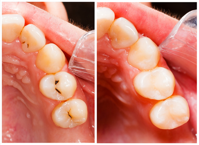 Fillings Roseville, CA