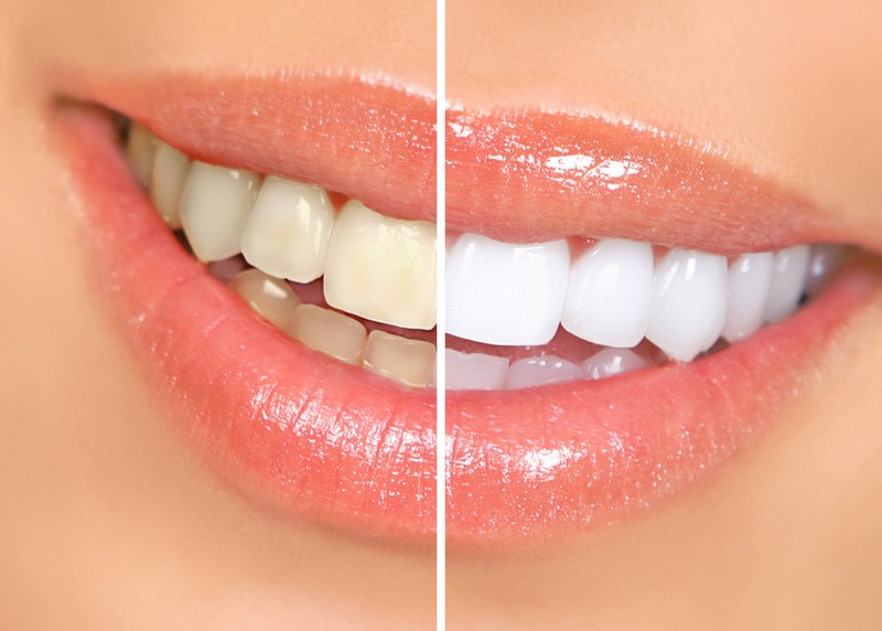 Teeth Whitening Roseville, CA