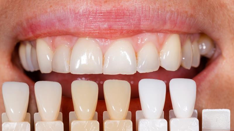 Veneers Roseville, CA